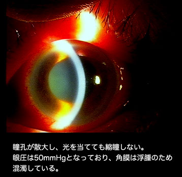 急性原発閉塞隅角緑内障(緑内障発作)